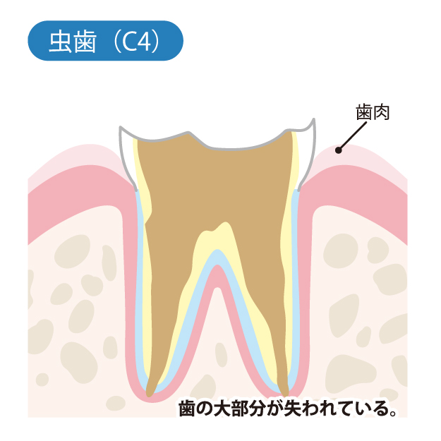 藤が丘駅徒歩1分の歯医者、マイデンタルオフィス藤が丘のなるべく削らず、痛くない治療