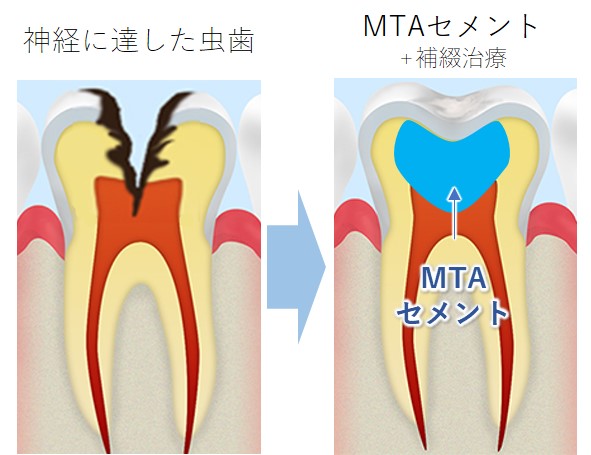 藤が丘駅徒歩1分の歯医者、マイデンタルオフィス藤が丘のなるべく削らず、痛くない治療