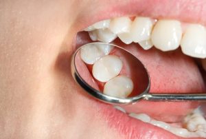 藤が丘駅徒歩1分の歯医者「マイデンタルオフィス藤が丘」で定期検診を受けているのに虫歯になった場合の歯科医師の見落とし責任について解説