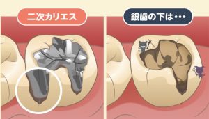 藤が丘駅徒歩1分の歯医者「マイデンタルオフィス藤が丘」で定期検診を受けているのに虫歯になった場合の歯科医師の見落とし責任について解説