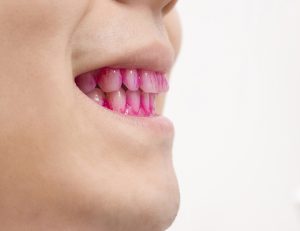 藤が丘駅徒歩1分の歯医者「マイデンタルオフィス藤が丘」で歯周病だと痩せにくい！ ダイエットを邪魔するお口の炎症について解説