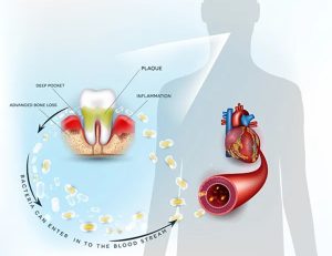 藤が丘駅徒歩1分の歯医者「マイデンタルオフィス藤が丘」で歯周病だと痩せにくい！ ダイエットを邪魔するお口の炎症について解説
