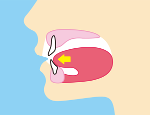 前歯が内側に傾いている？その原因やリスク、治療法を解説
