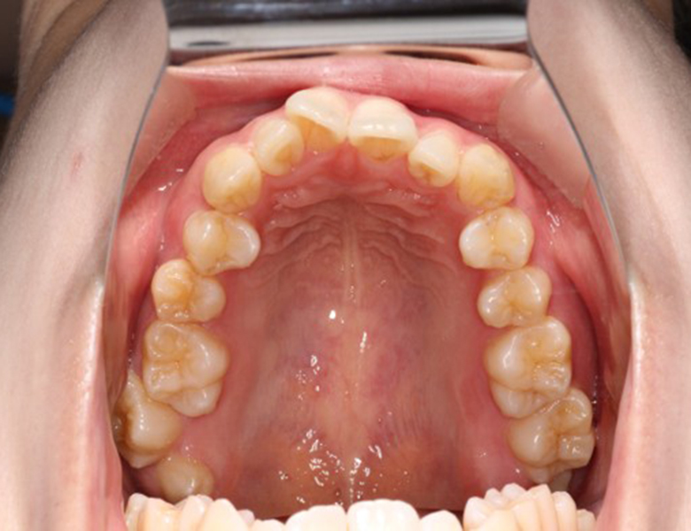 藤が丘駅徒歩1分の歯医者「マイデンタルオフィス藤が丘」横浜市青葉区のインビザライン治療症例