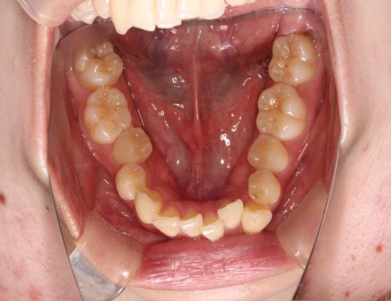 藤が丘駅徒歩1分の歯医者「マイデンタルオフィス藤が丘」横浜市青葉区のインビザライン治療症例