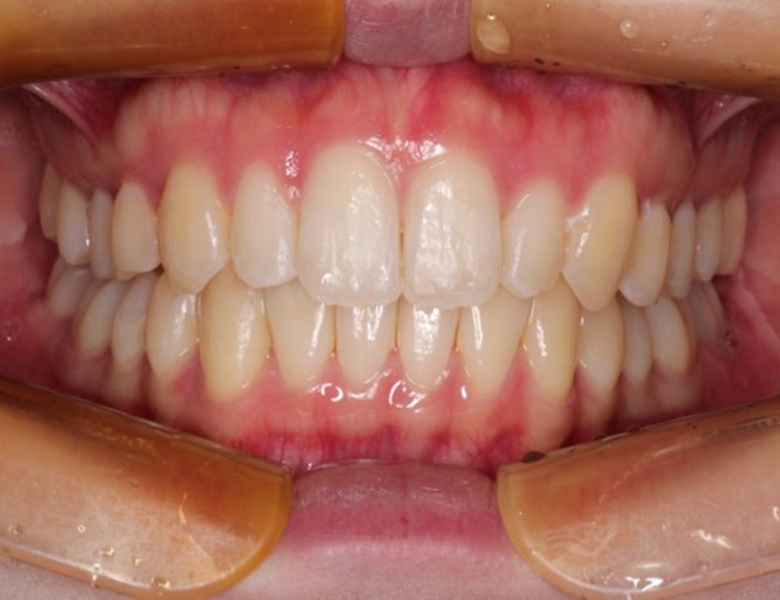 藤が丘駅徒歩1分の歯医者「マイデンタルオフィス藤が丘」横浜市青葉区のインビザライン治療症例