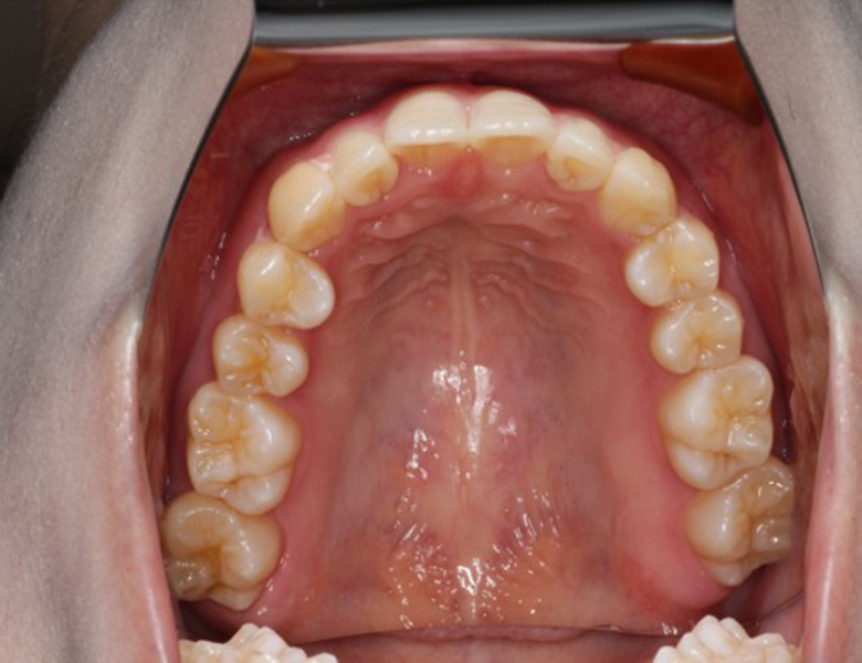 藤が丘駅徒歩1分の歯医者「マイデンタルオフィス藤が丘」横浜市青葉区のインビザライン治療症例