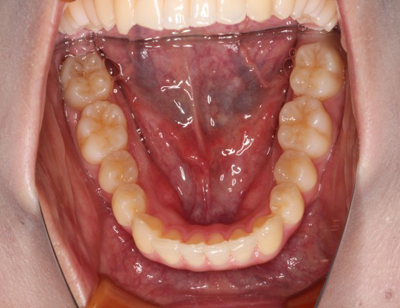 藤が丘駅徒歩1分の歯医者「マイデンタルオフィス藤が丘」横浜市青葉区のインビザライン治療症例