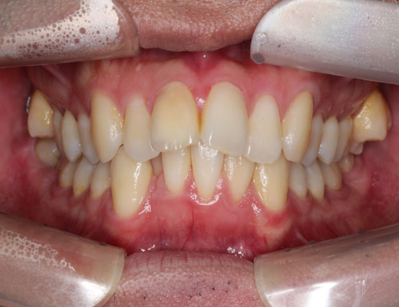 藤が丘駅徒歩1分の歯医者「マイデンタルオフィス藤が丘」横浜市青葉区のインビザライン治療症例