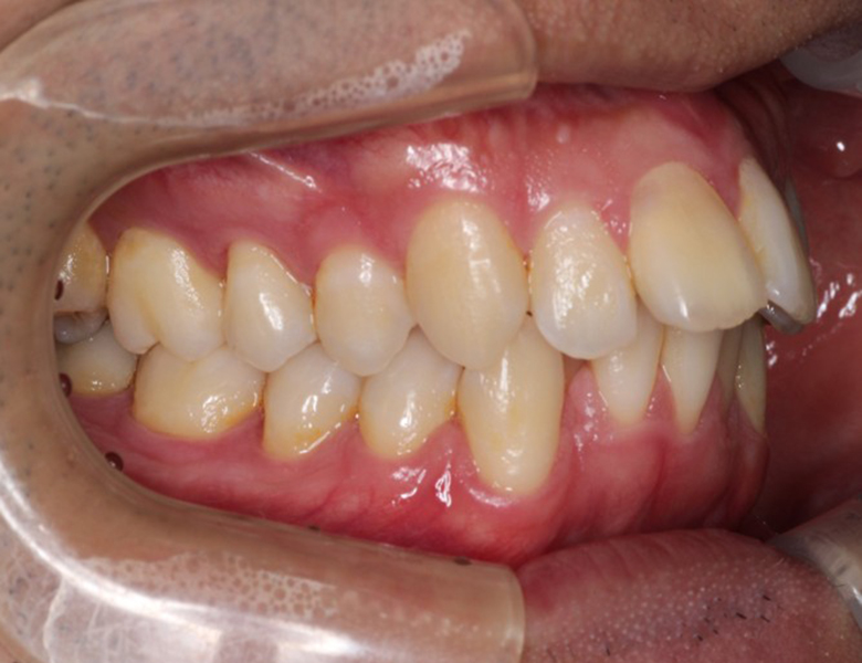 藤が丘駅徒歩1分の歯医者「マイデンタルオフィス藤が丘」横浜市青葉区のインビザライン治療症例