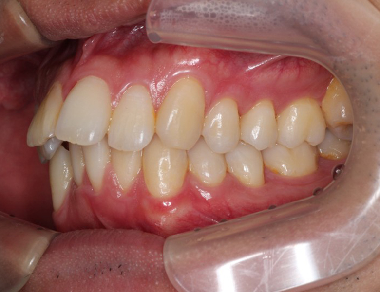 藤が丘駅徒歩1分の歯医者「マイデンタルオフィス藤が丘」横浜市青葉区のインビザライン治療症例