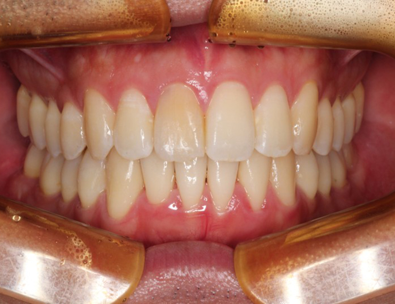 藤が丘駅徒歩1分の歯医者「マイデンタルオフィス藤が丘」横浜市青葉区のインビザライン治療症例