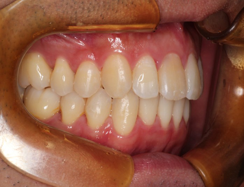 藤が丘駅徒歩1分の歯医者「マイデンタルオフィス藤が丘」横浜市青葉区のインビザライン治療症例