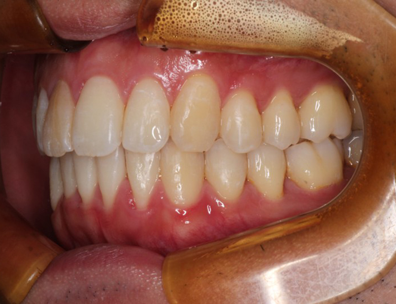 藤が丘駅徒歩1分の歯医者「マイデンタルオフィス藤が丘」横浜市青葉区のインビザライン治療症例