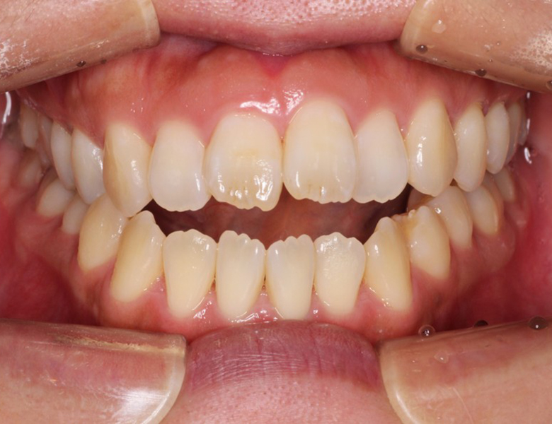 藤が丘駅徒歩1分の歯医者「マイデンタルオフィス藤が丘」横浜市青葉区のインビザライン治療症例