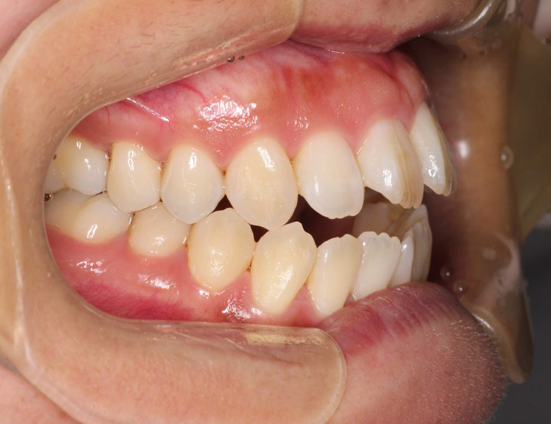藤が丘駅徒歩1分の歯医者「マイデンタルオフィス藤が丘」横浜市青葉区のインビザライン治療症例