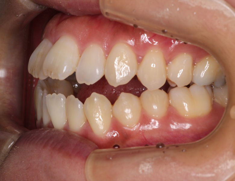 藤が丘駅徒歩1分の歯医者「マイデンタルオフィス藤が丘」横浜市青葉区のインビザライン治療症例