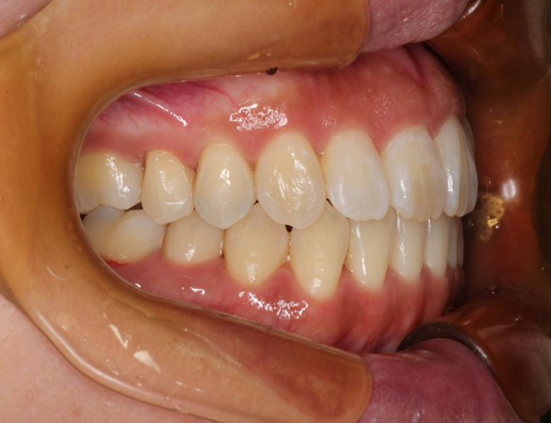 藤が丘駅徒歩1分の歯医者「マイデンタルオフィス藤が丘」横浜市青葉区のインビザライン治療症例