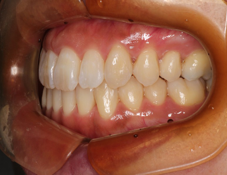 藤が丘駅徒歩1分の歯医者「マイデンタルオフィス藤が丘」横浜市青葉区のインビザライン治療症例