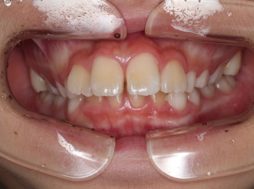 藤が丘駅徒歩1分の歯医者「マイデンタルオフィス藤が丘」横浜市青葉区のインビザライン治療症例