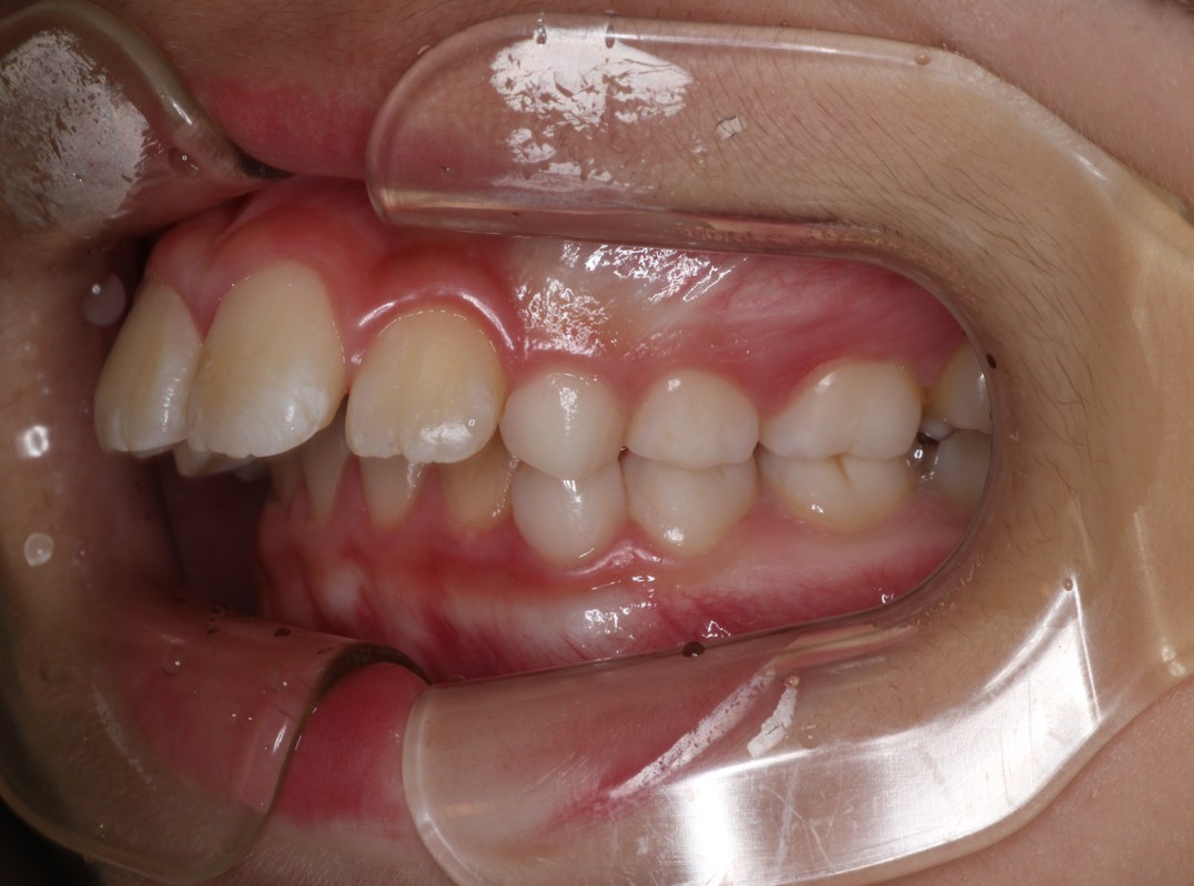 藤が丘駅徒歩1分の歯医者「マイデンタルオフィス藤が丘」横浜市青葉区のインビザライン治療症例