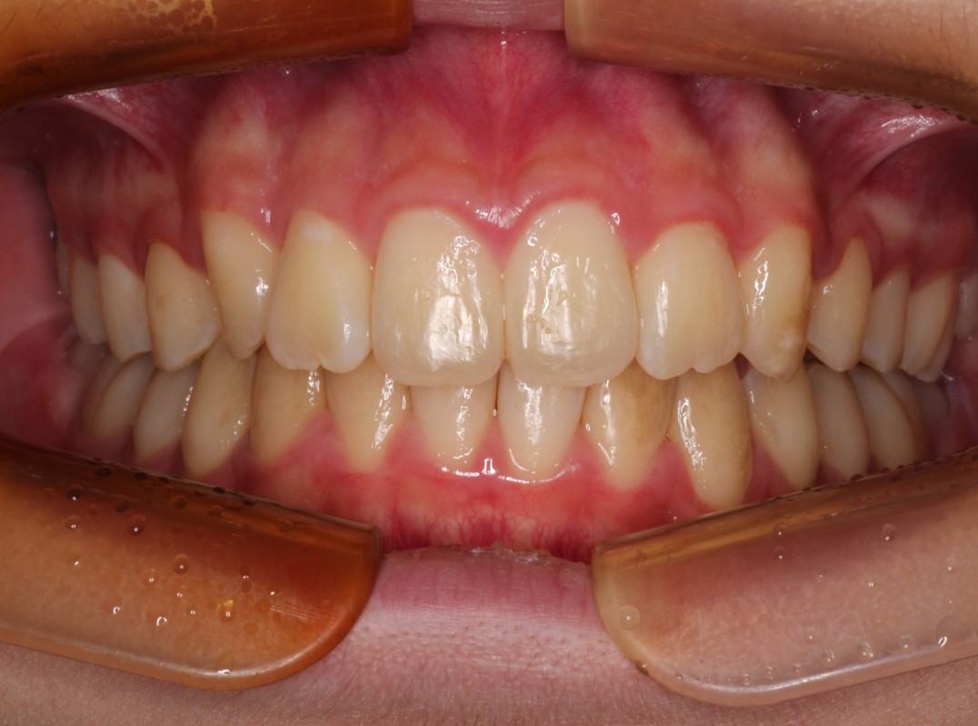 藤が丘駅徒歩1分の歯医者「マイデンタルオフィス藤が丘」横浜市青葉区のインビザライン治療症例