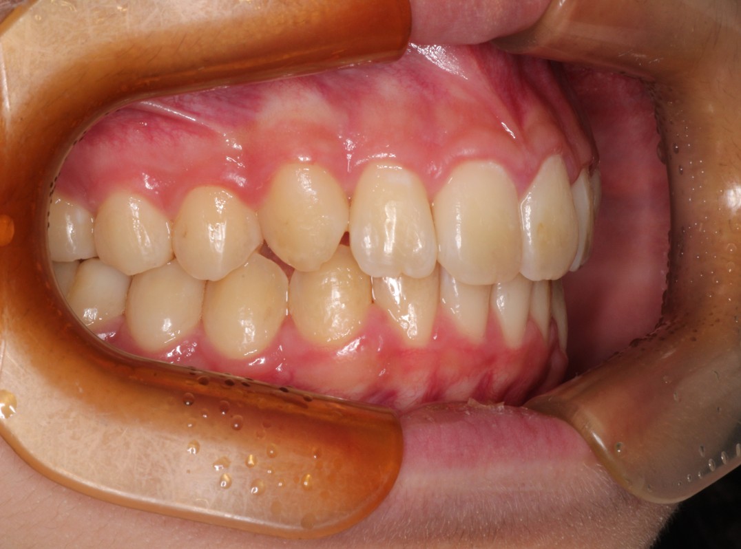 藤が丘駅徒歩1分の歯医者「マイデンタルオフィス藤が丘」横浜市青葉区のインビザライン治療症例