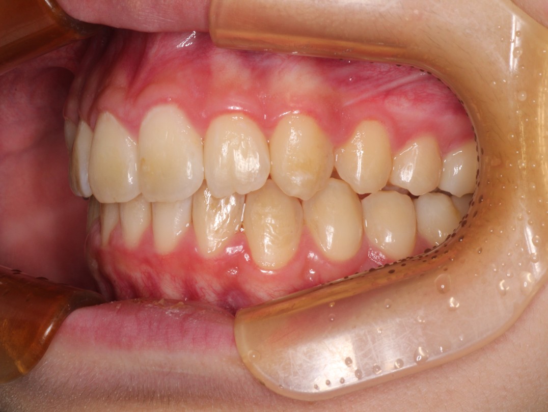 藤が丘駅徒歩1分の歯医者「マイデンタルオフィス藤が丘」横浜市青葉区のインビザライン治療症例