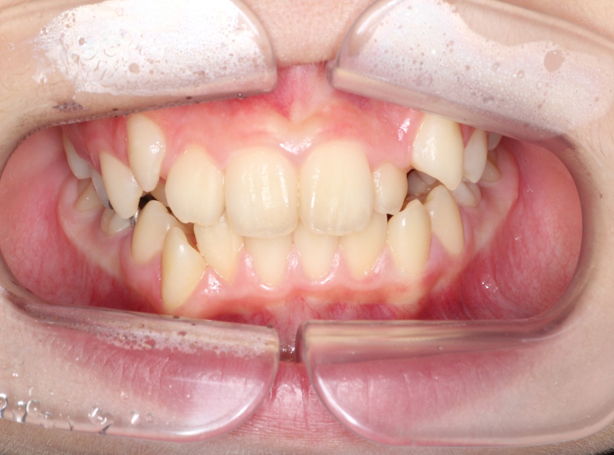 藤が丘駅徒歩1分の歯医者「マイデンタルオフィス藤が丘」横浜市青葉区のインビザライン治療症例