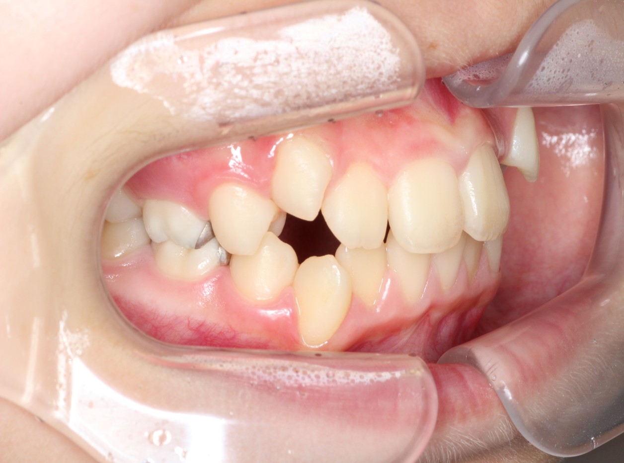 藤が丘駅徒歩1分の歯医者「マイデンタルオフィス藤が丘」横浜市青葉区のインビザライン治療症例