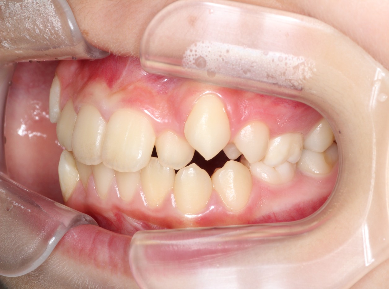 藤が丘駅徒歩1分の歯医者「マイデンタルオフィス藤が丘」横浜市青葉区のインビザライン治療症例