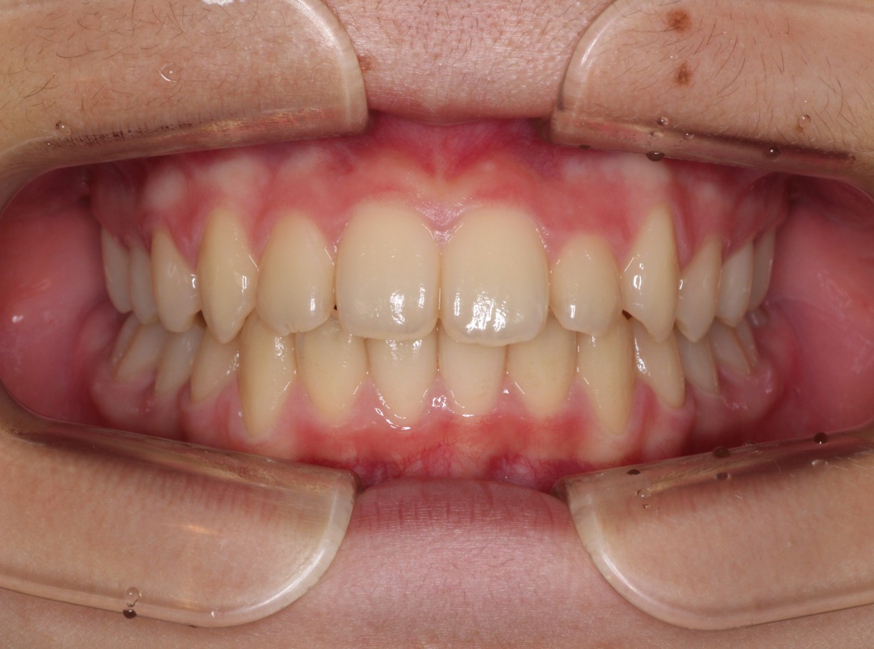 藤が丘駅徒歩1分の歯医者「マイデンタルオフィス藤が丘」横浜市青葉区のインビザライン治療症例