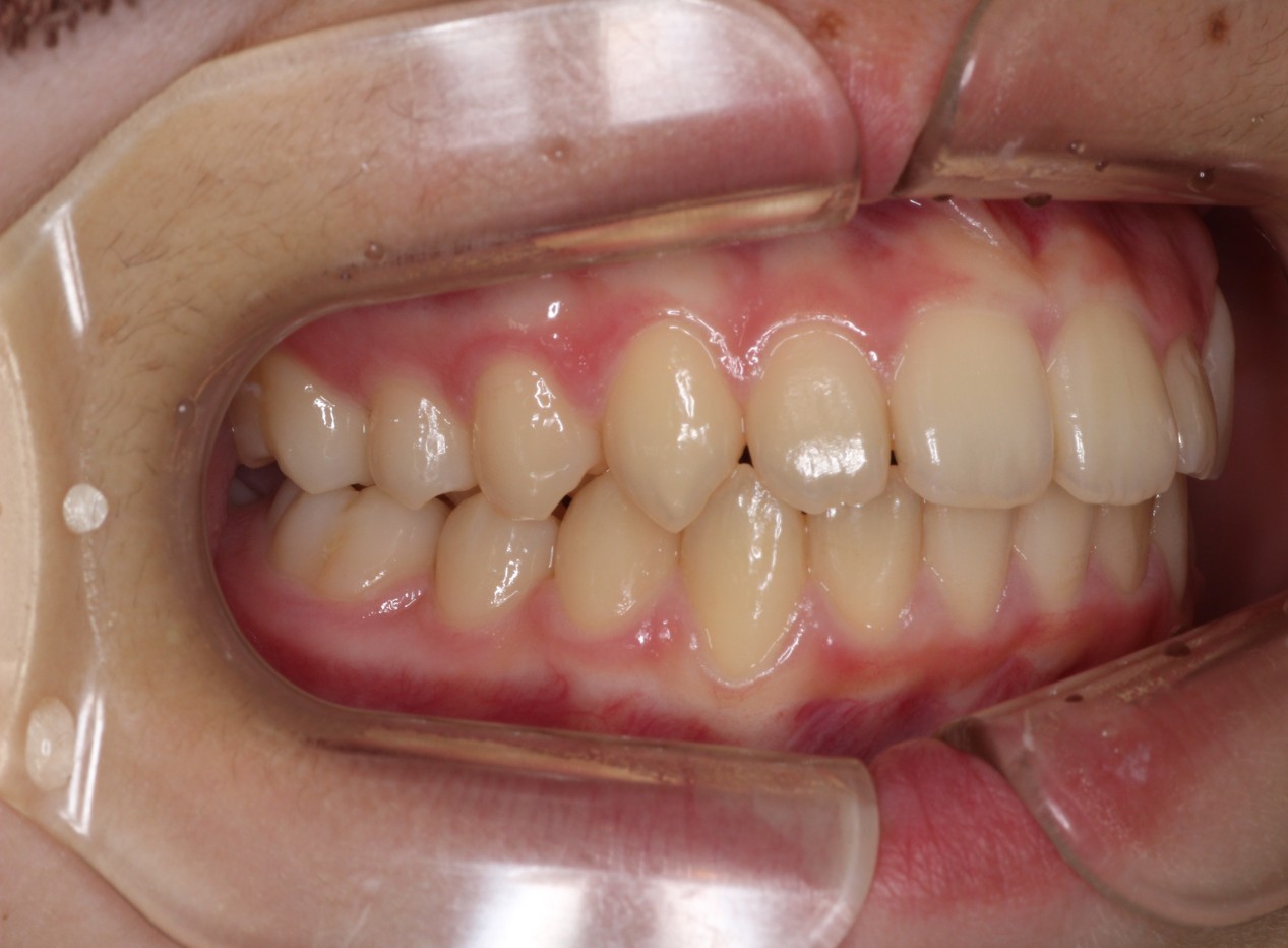 藤が丘駅徒歩1分の歯医者「マイデンタルオフィス藤が丘」横浜市青葉区のインビザライン治療症例