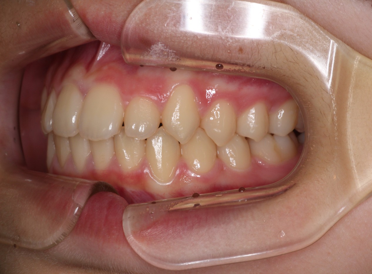 藤が丘駅徒歩1分の歯医者「マイデンタルオフィス藤が丘」横浜市青葉区のインビザライン治療症例