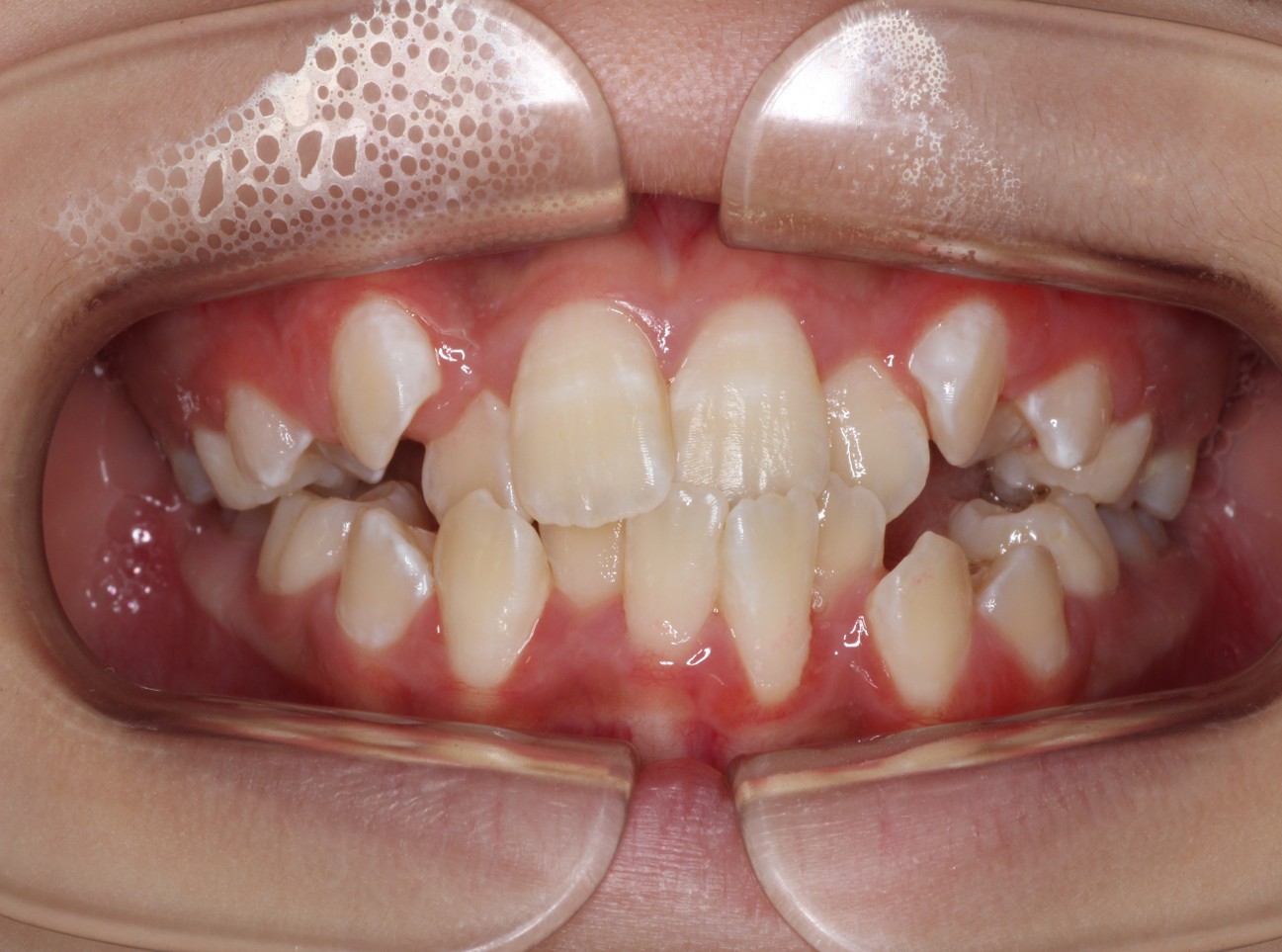 藤が丘駅徒歩1分の歯医者「マイデンタルオフィス藤が丘」横浜市青葉区のインビザライン治療症例