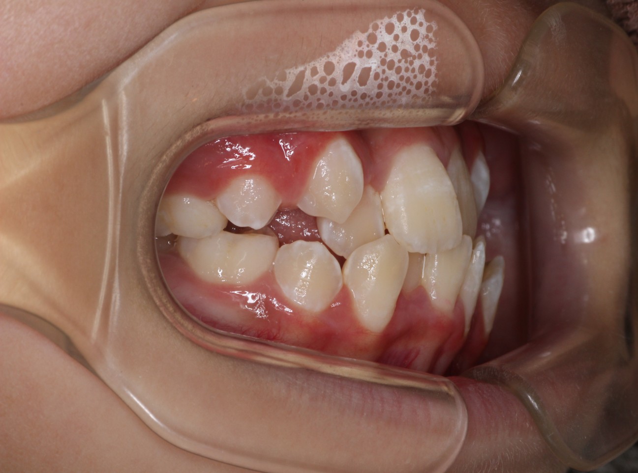 藤が丘駅徒歩1分の歯医者「マイデンタルオフィス藤が丘」横浜市青葉区のインビザライン治療症例