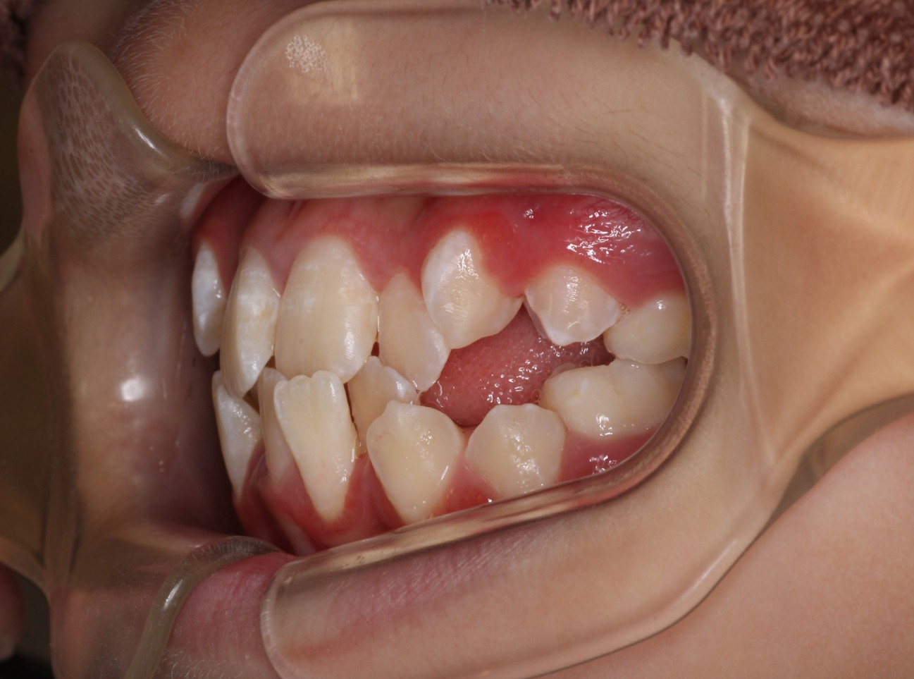 藤が丘駅徒歩1分の歯医者「マイデンタルオフィス藤が丘」横浜市青葉区のインビザライン治療症例