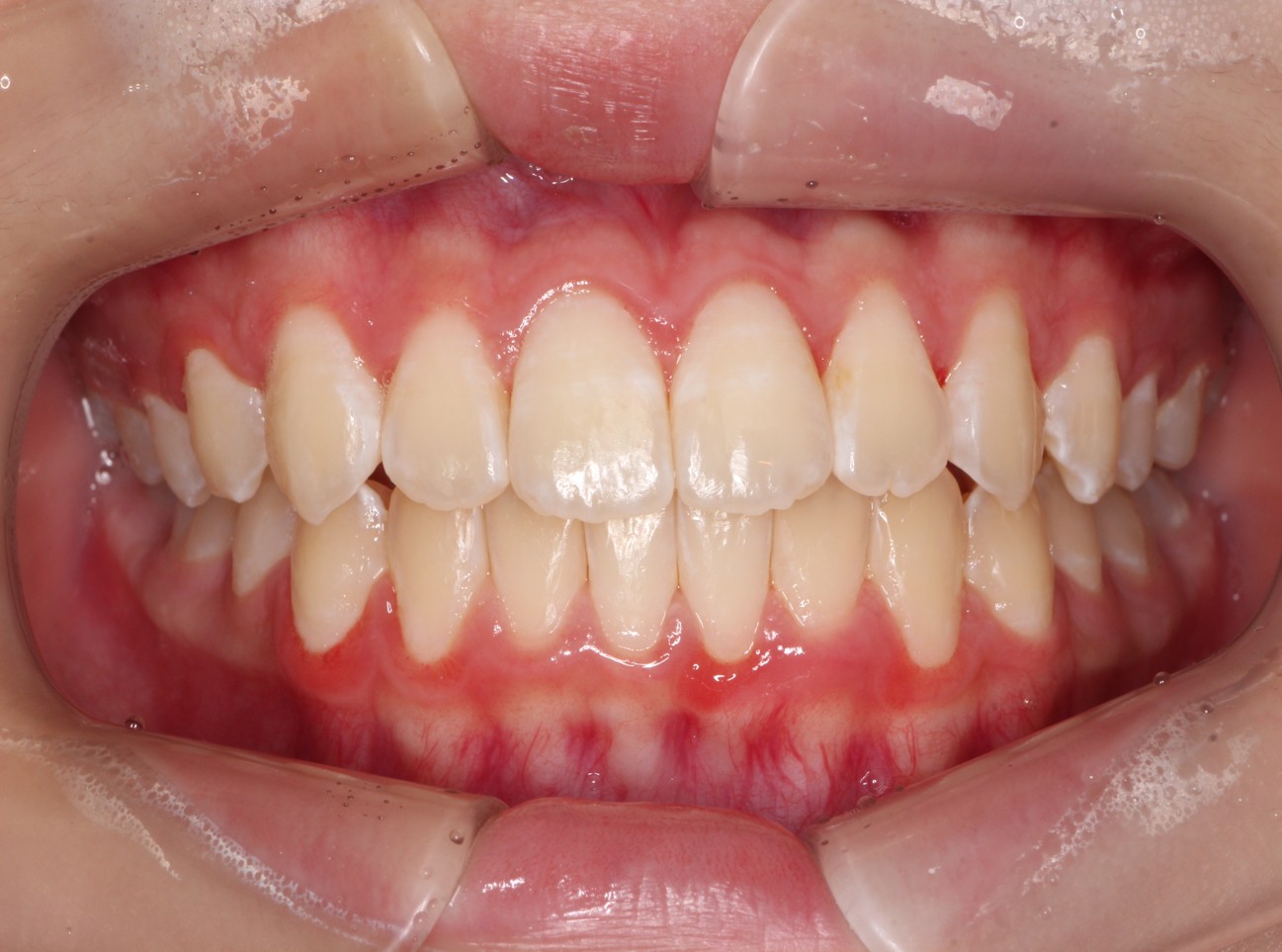 藤が丘駅徒歩1分の歯医者「マイデンタルオフィス藤が丘」横浜市青葉区のインビザライン治療症例