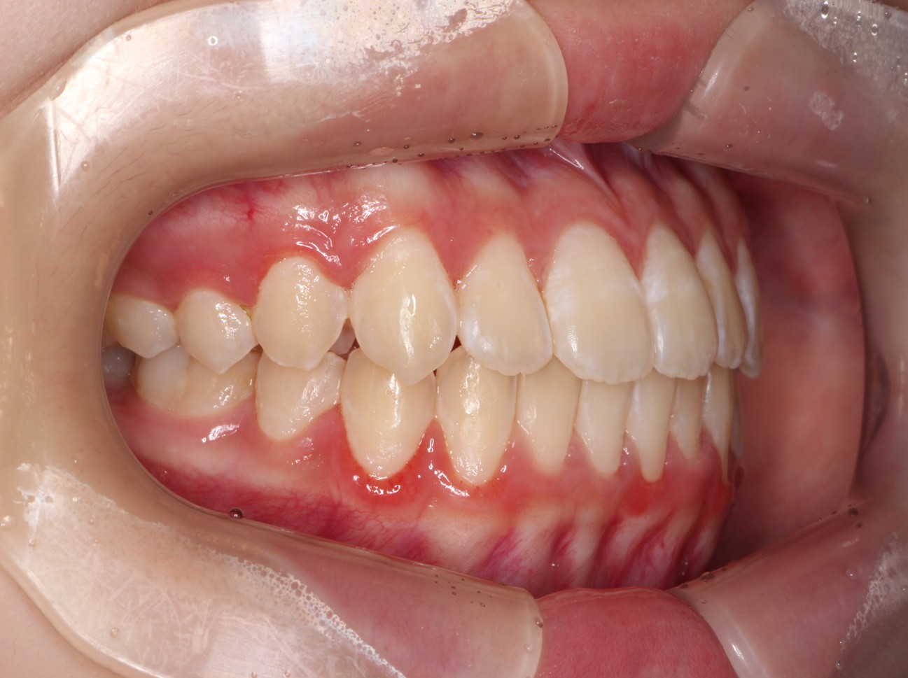 藤が丘駅徒歩1分の歯医者「マイデンタルオフィス藤が丘」横浜市青葉区のインビザライン治療症例