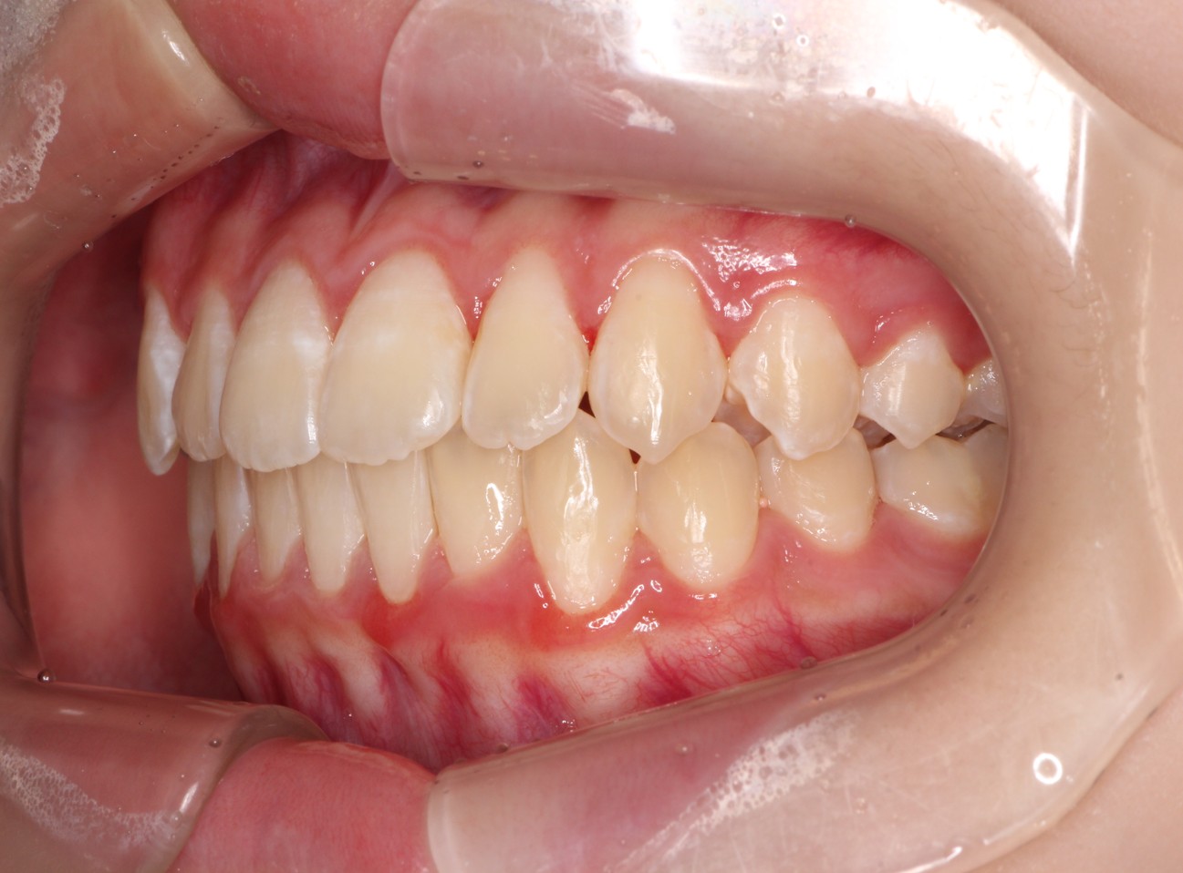 藤が丘駅徒歩1分の歯医者「マイデンタルオフィス藤が丘」横浜市青葉区のインビザライン治療症例